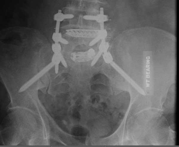 Spine x-ray 3  11-5-25.jpg