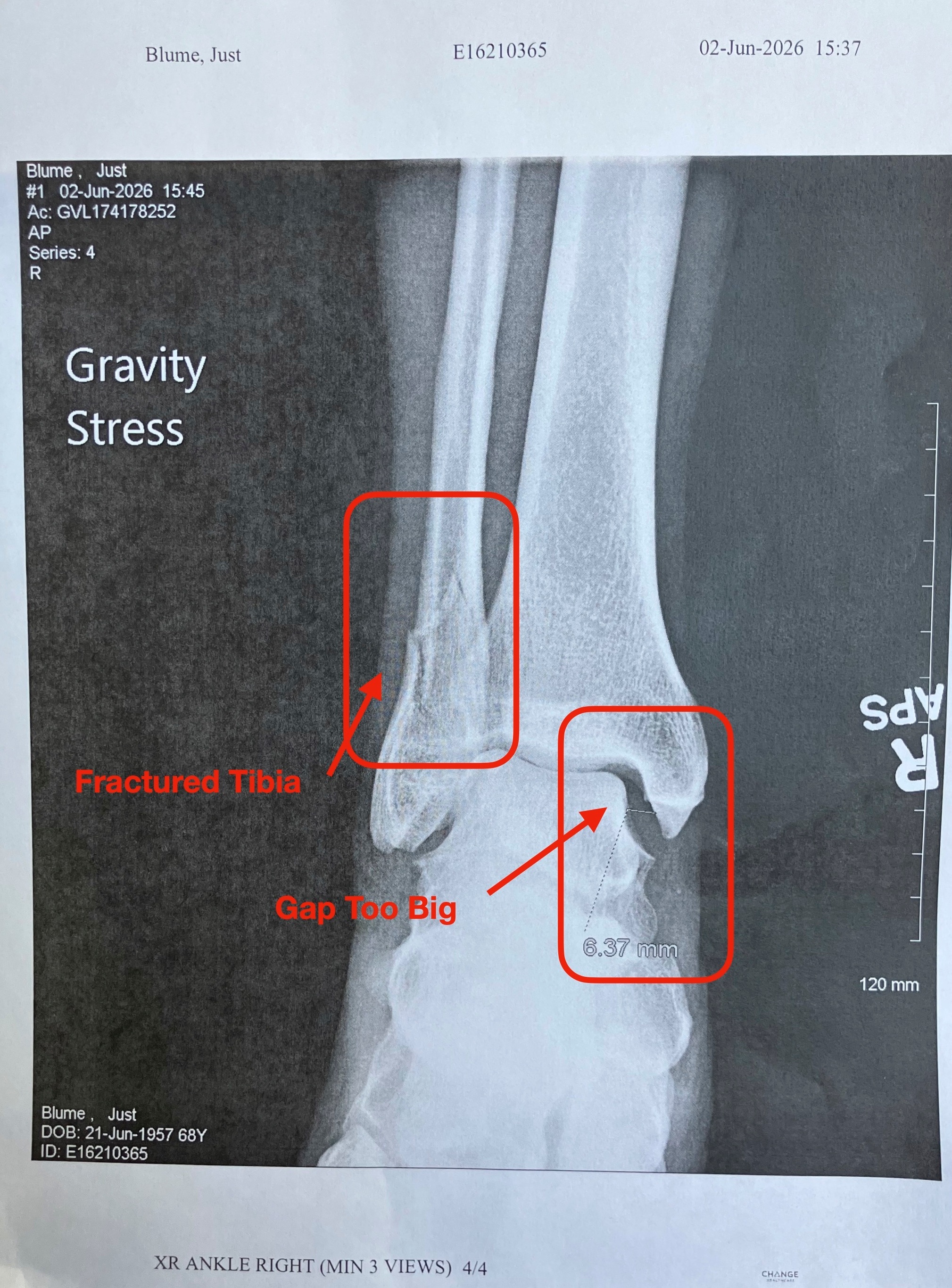 ankle x-ray.jpg