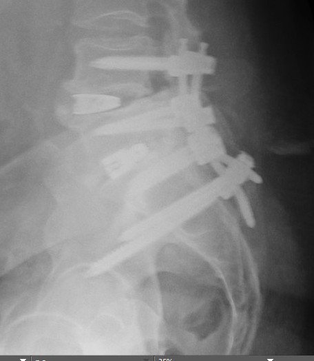 Spine x-ray 4  11-5-25.jpg
